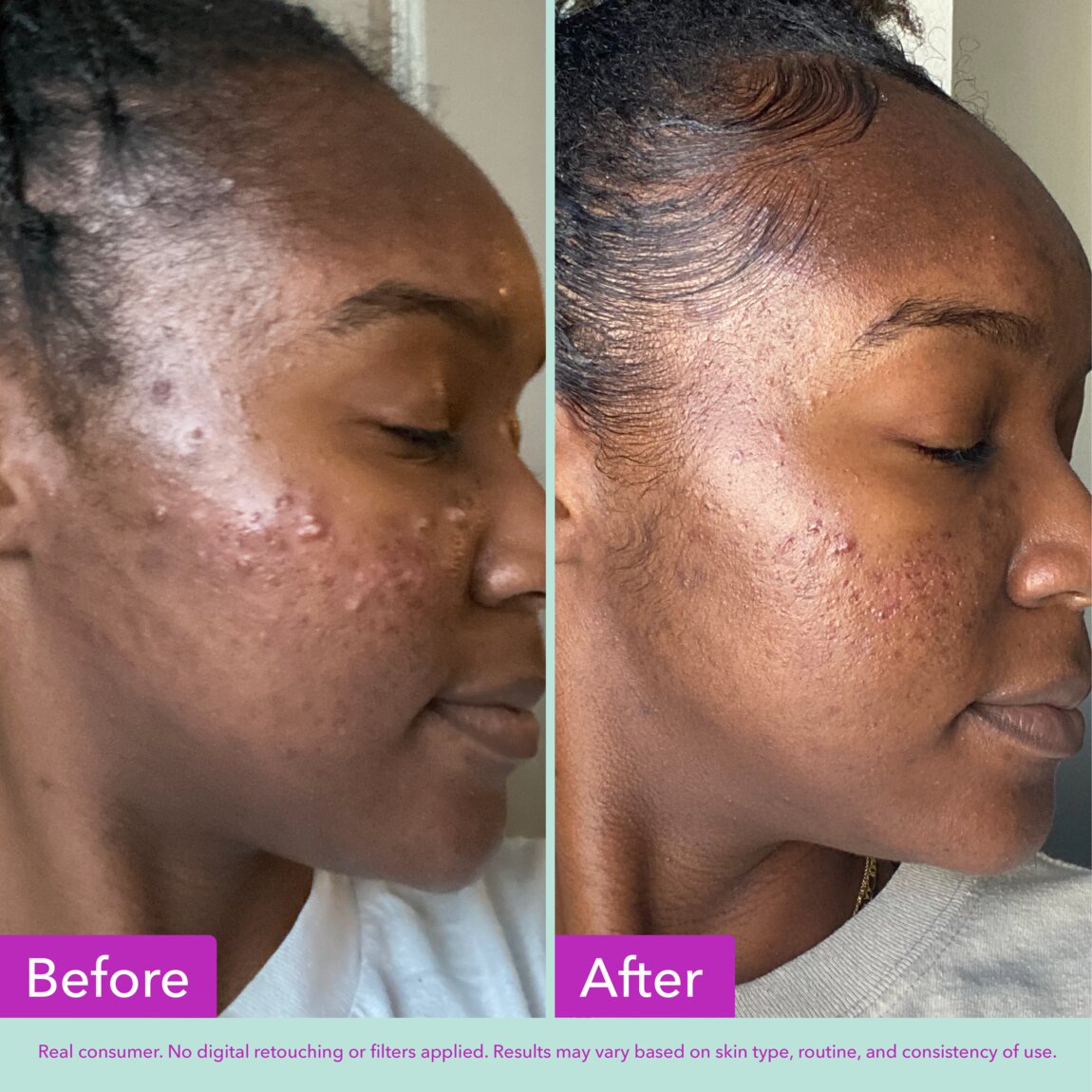 acne-foaming-cleanser-n3 zb_p.jpg