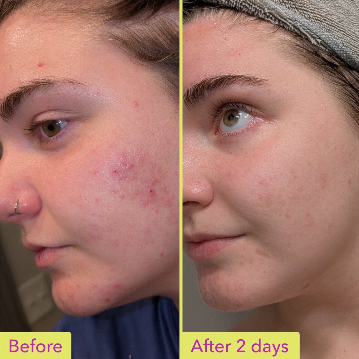 10-azelaic-acid-treatment-k9 zb_p.jpg