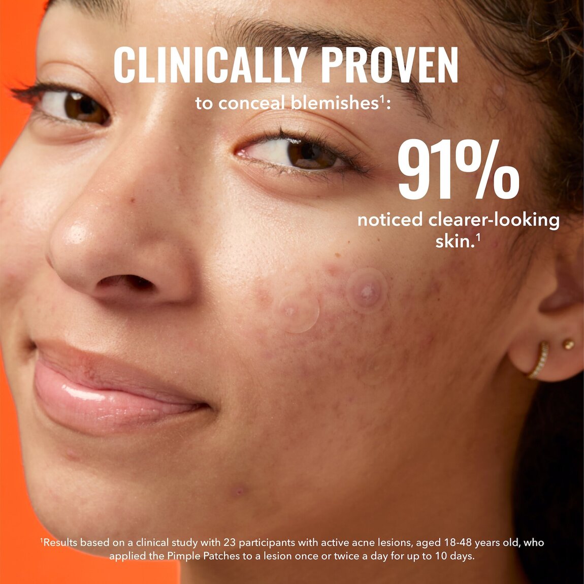pimple-patches-x4 zb_p.jpg